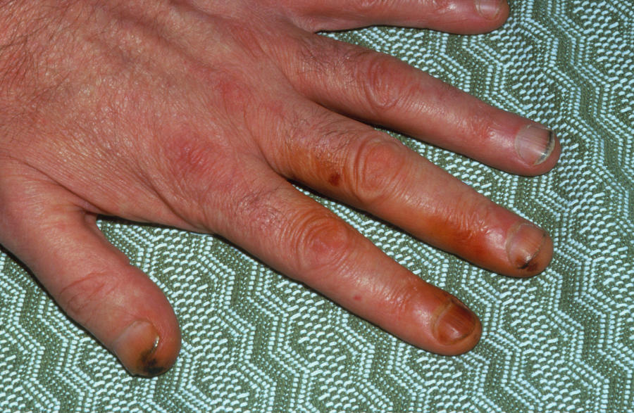tobacco staining Hand With Tar Stains From Cigarette Smoking Photograph by James Stevenson /  Science Photo Library