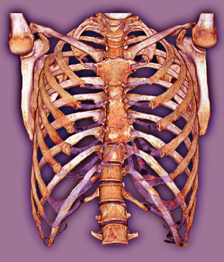 Rib Cage Photograph by Zephyr / Science Photo Library - Pixels