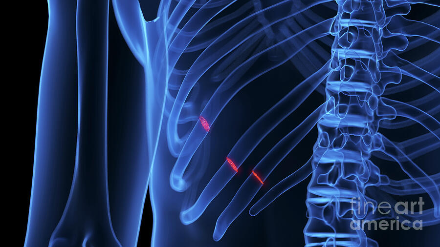 Broken Ribs Photograph by 3Dmedisphere / Science Photo Library - Pixels